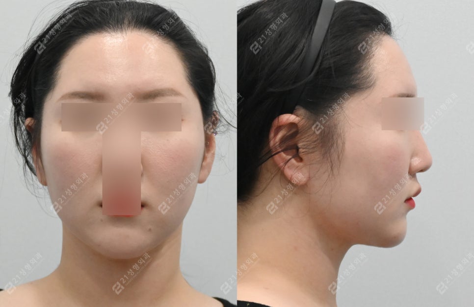 얼굴지방흡입붓기 2개월차 전후경과 관련 이미지 3