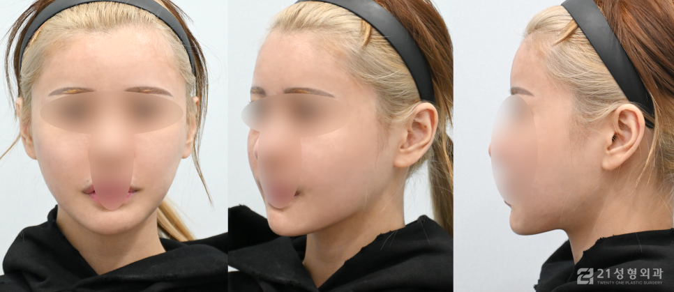 안면윤곽성형외과 갸름해진 얼굴 라인 관련 이미지 4