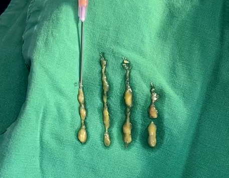 Could a lump you feel after fat grafting be cancer? image 3
