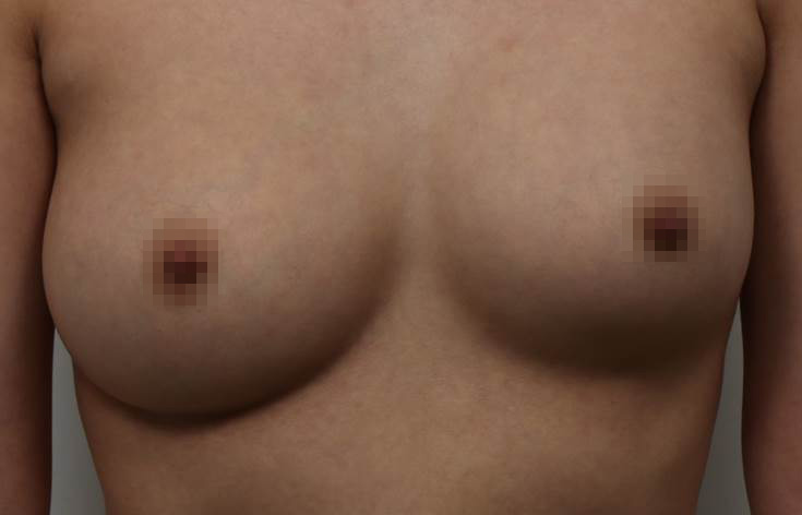 가슴 수술!수술 전 어떠한 진찰이 필요할까? 관련 이미지 7