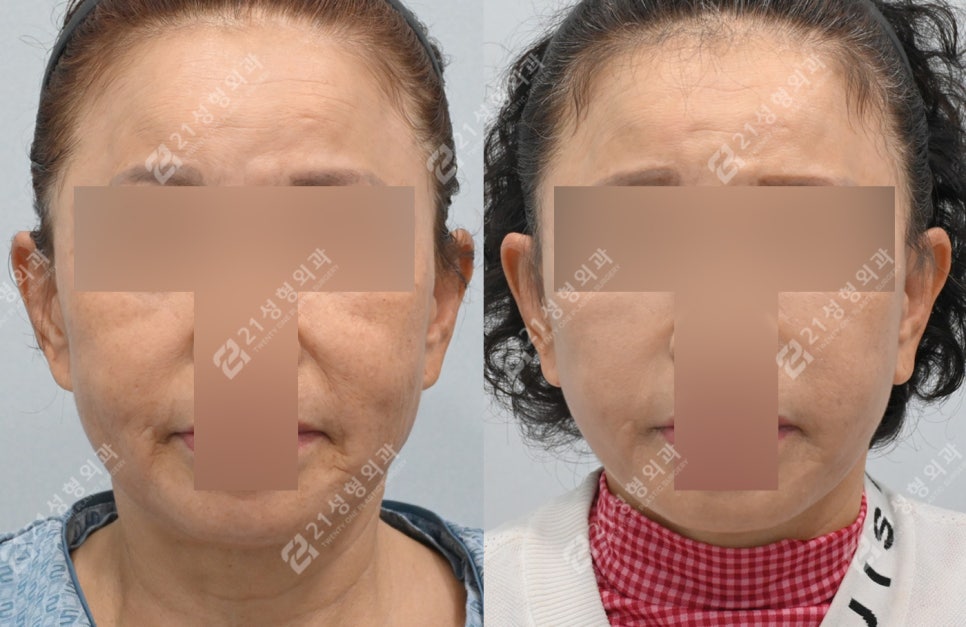 이렇게나 달라져요? 전후 차이 확실한 안면목거상 관련 이미지 2