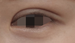 [눈 성형] 낮은 쌍꺼풀 높이기~ 관련 이미지 7