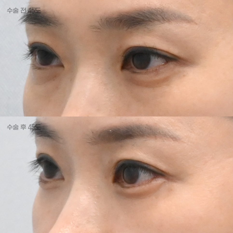 상담할 때 눈밑 피부를 먼저 확인하는 이유 관련 이미지 2
