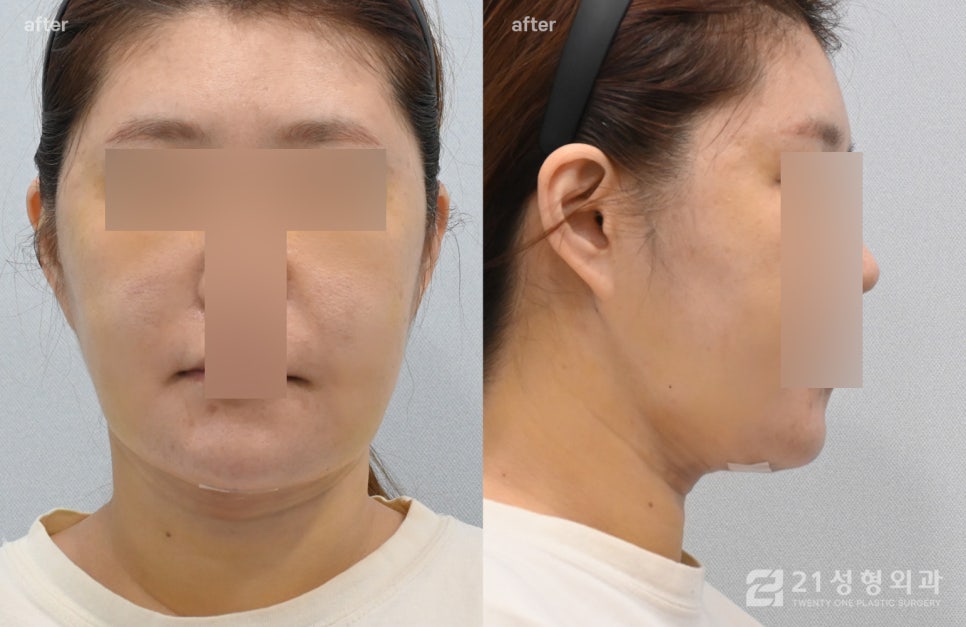 이중턱수술 실제 환자 사례, 지방 흡입부터 근육묶기까지 총정리 관련 이미지 4