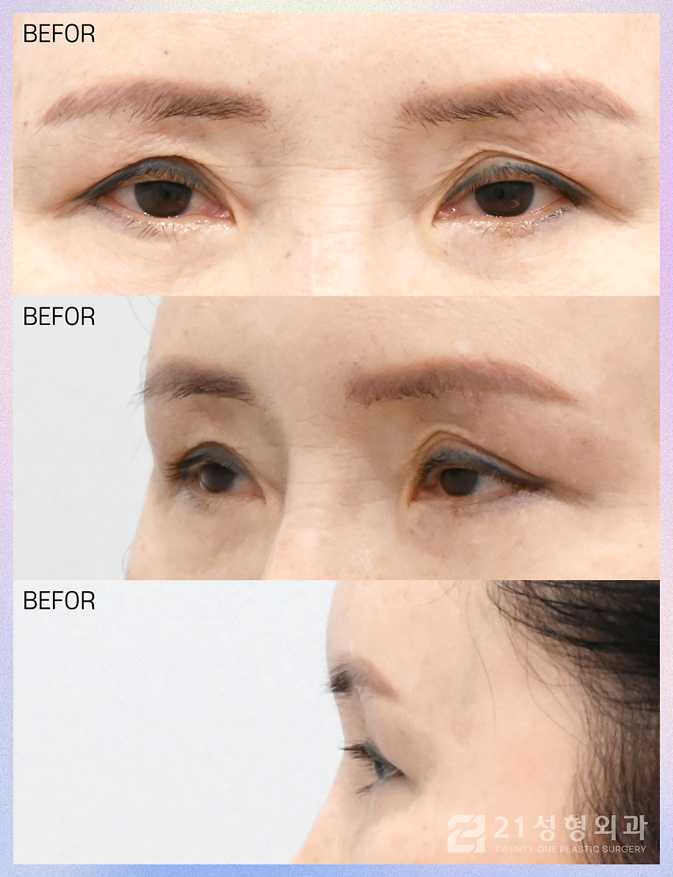 상안검수술흉터 걱정되신다면 관련 이미지 6