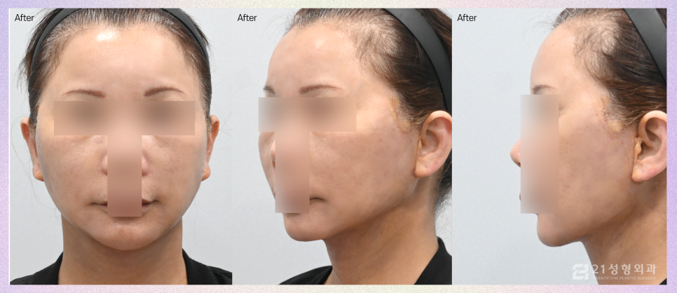 안면거상술잘하는곳 결정할 때 중요한 부분 관련 이미지 8