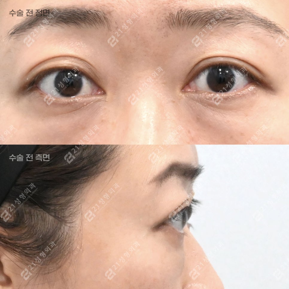 If People Always Tell You That You Look Tired, Could Under-Eye Fat Be the Cause? image 1