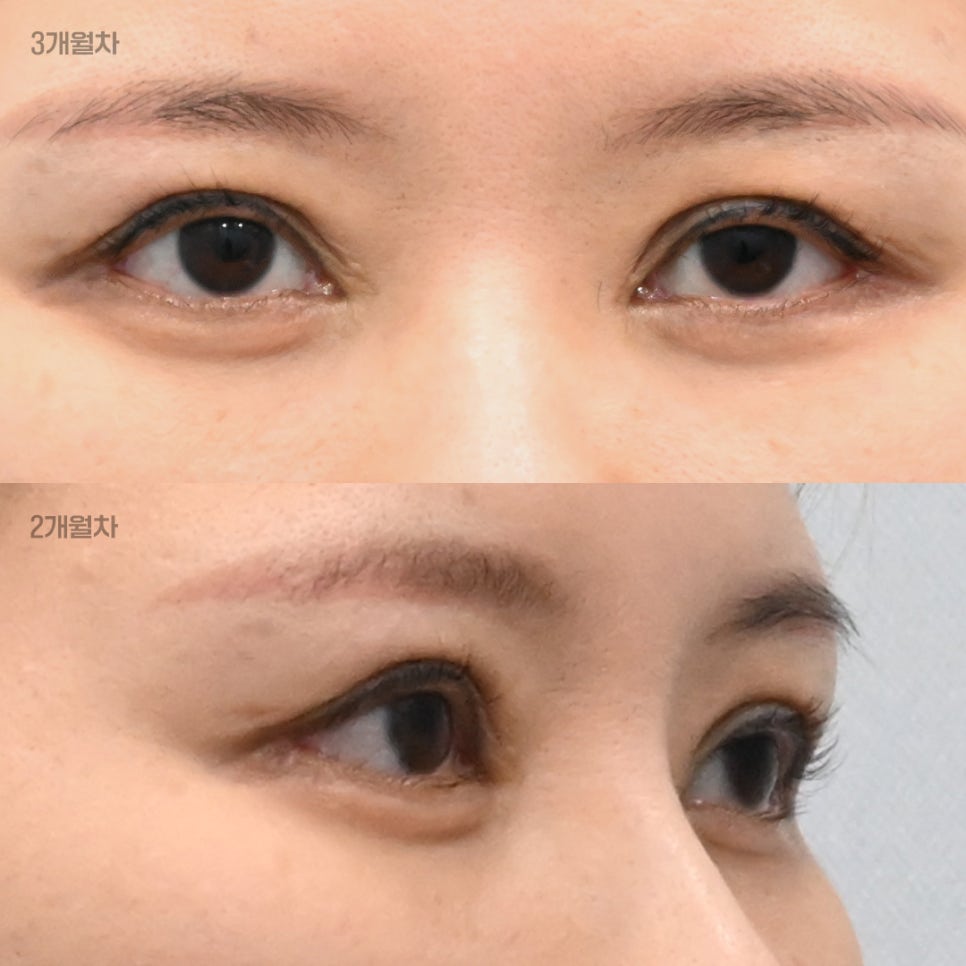 What Is the Most Efficient Combination of Plastic Surgery Procedures That Can Be Completed at Once, Without Going Through the Same Ordeal Twice? image 5