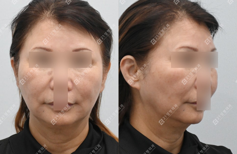 Mid-Face Lift Revision Surgery Case in a Patient in Their 60s image 2