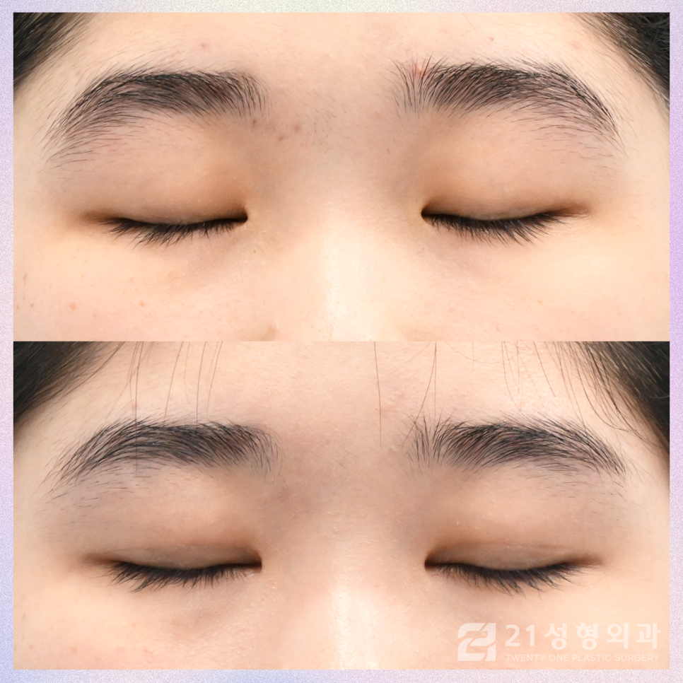 쌍꺼풀절개수술 안검하수를 효과적으로 개선하는 방법 관련 이미지 2