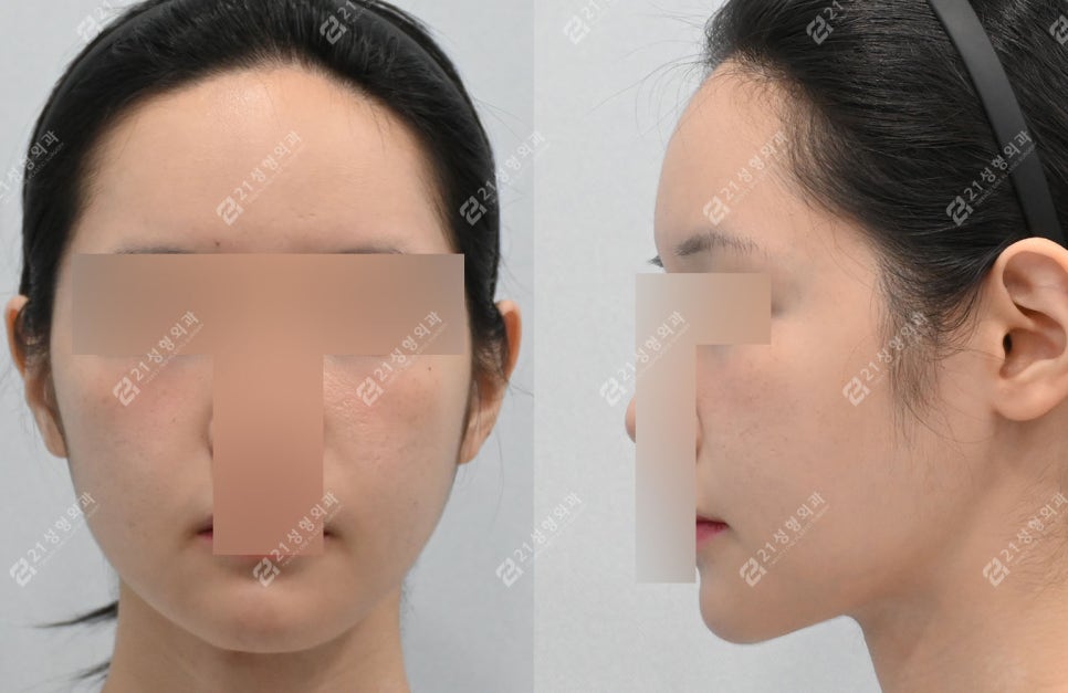 Double Chin Surgery, There Was Actually Another Cause (Real Case Analysis) image 5