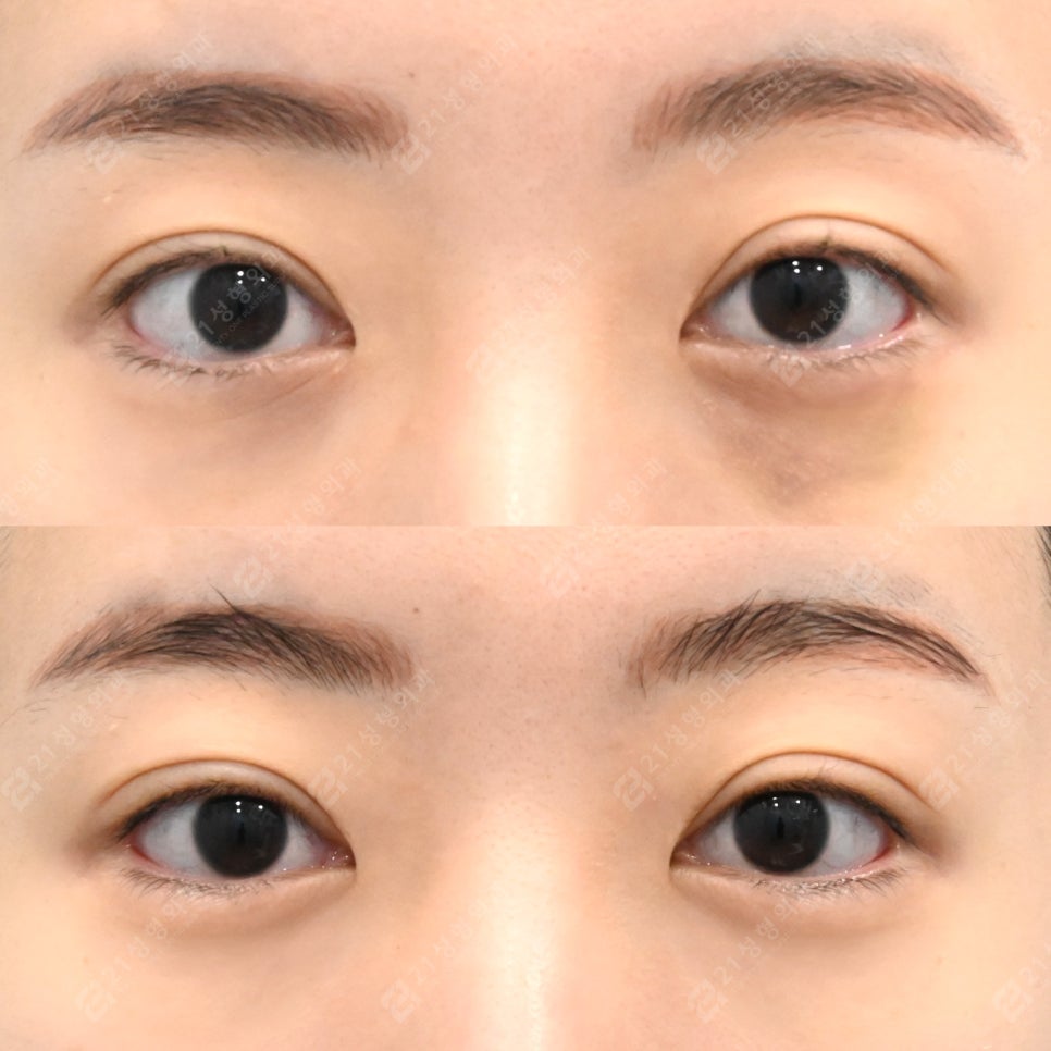 똑같은 눈밑수술도 결과가 다른 이유 관련 이미지 1