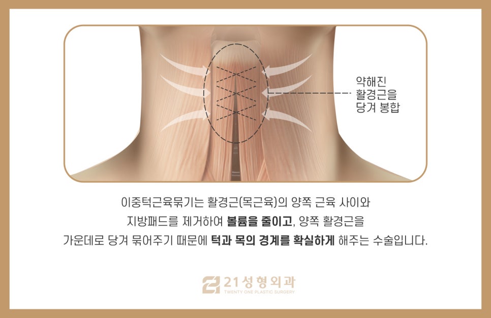 턱살제거수술로 매끈한 V라인 관련 이미지 6