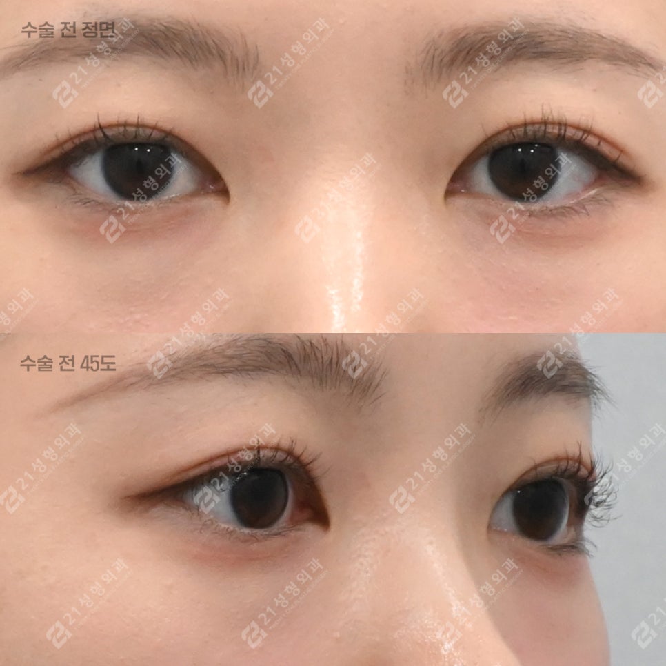 다크서클도, 애교살도 21성형외과에서 한 번에 해결! 관련 이미지 4
