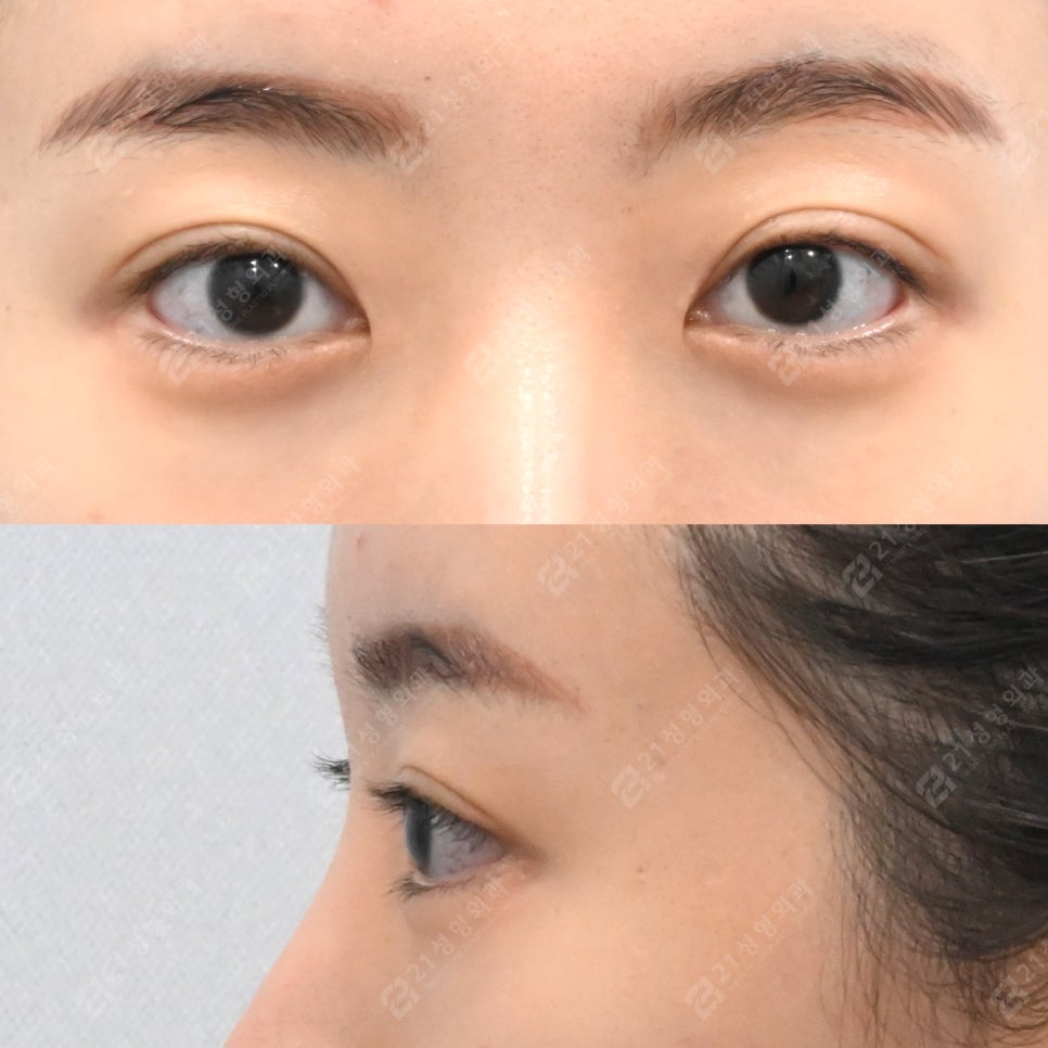 똑같은 눈밑수술도 결과가 다른 이유 관련 이미지 4