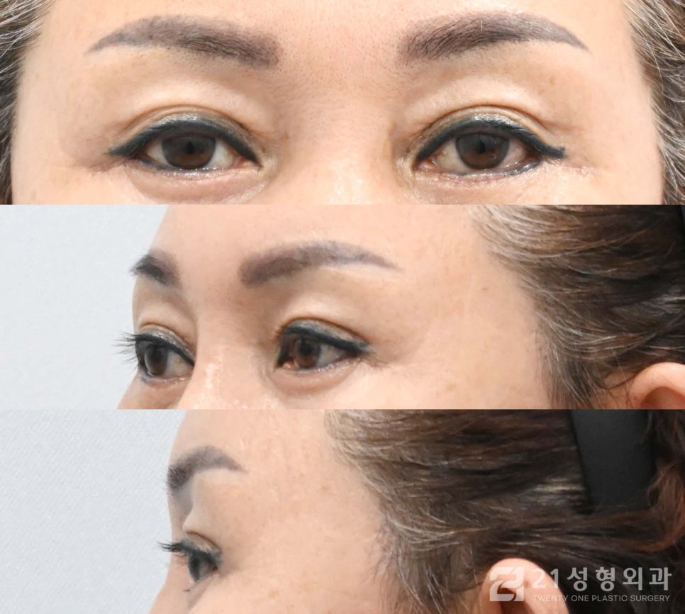 상안검수술흉터 안 보이게 하려면 관련 이미지 4