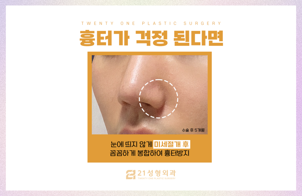 콧볼축소술로 얼굴 밸런스를 맞추기 위해서는 관련 이미지 5