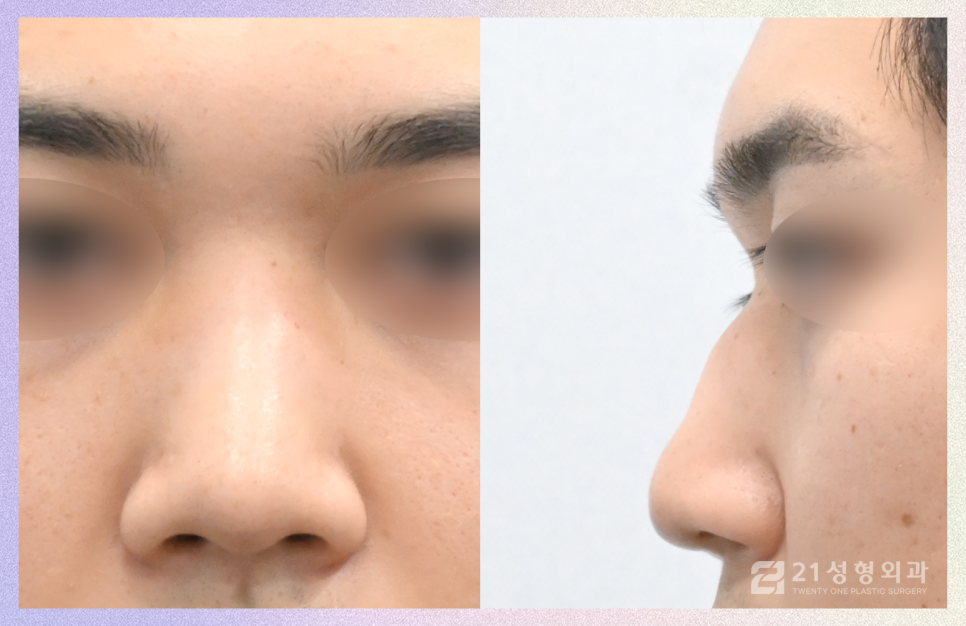강남남자코수술 잘하는 병원의 기준 관련 이미지 4