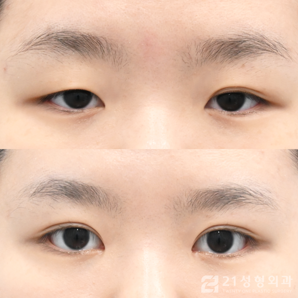 강남쌍꺼풀수술잘하는곳 찾아보는 포인트 관련 이미지 1