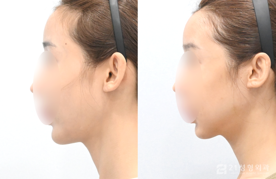 사각턱수술잘하는곳 정보를 알고 싶다면 관련 이미지 3