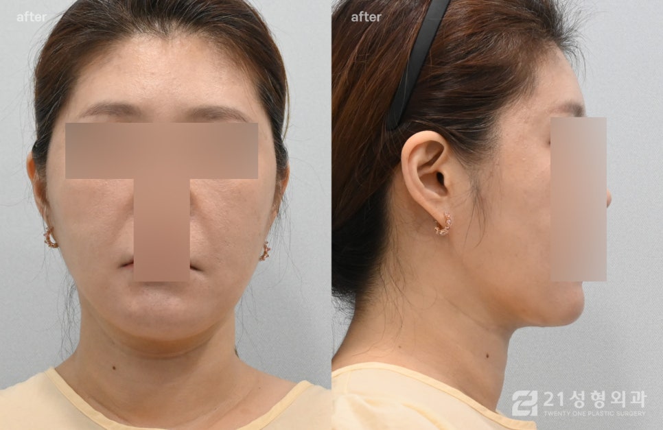 이중턱수술 실제 환자 사례, 지방 흡입부터 근육묶기까지 총정리 관련 이미지 6