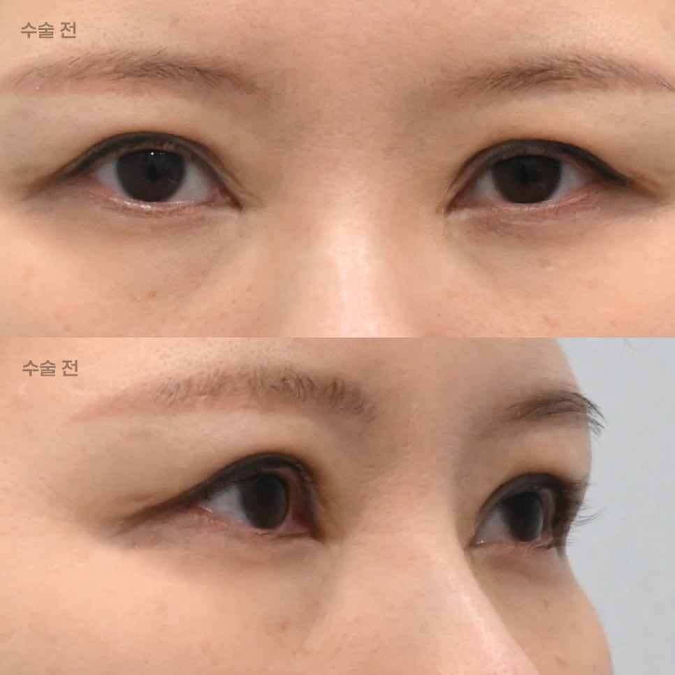 What Is the Most Efficient Combination of Plastic Surgery Procedures That Can Be Completed at Once, Without Going Through the Same Ordeal Twice? image 3