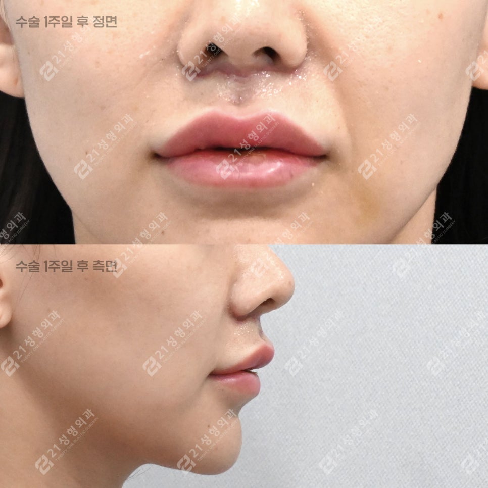인중축소 후 얼굴이 더 입체적으로 보인 이유, 인중오목술 때문이었습니다 관련 이미지 3