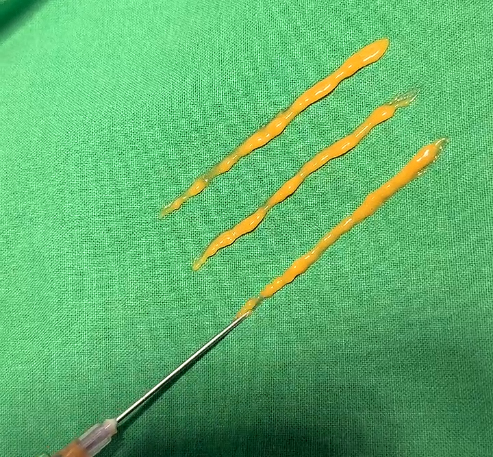Could a lump you feel after fat grafting be cancer? image 5
