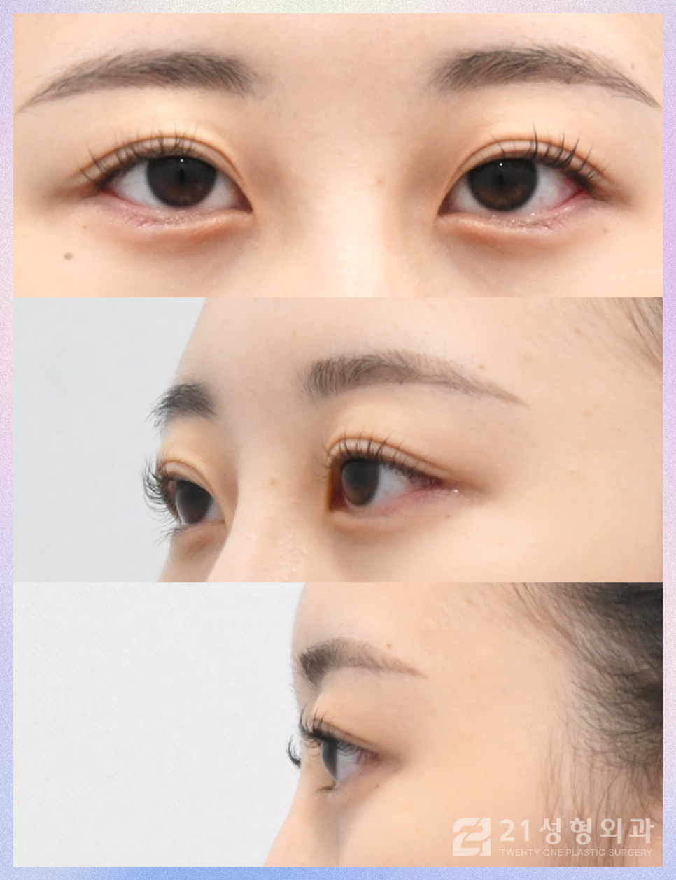 눈트임성형으로 크고 선명하게 관련 이미지 7
