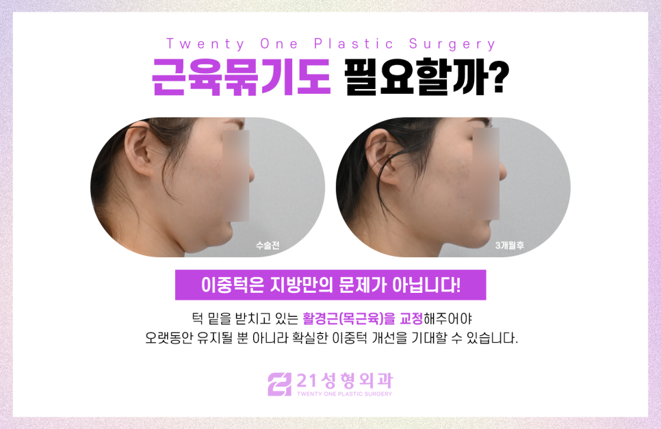 이중턱흡입 후 뚜렷해진 턱 라인 관련 이미지 4