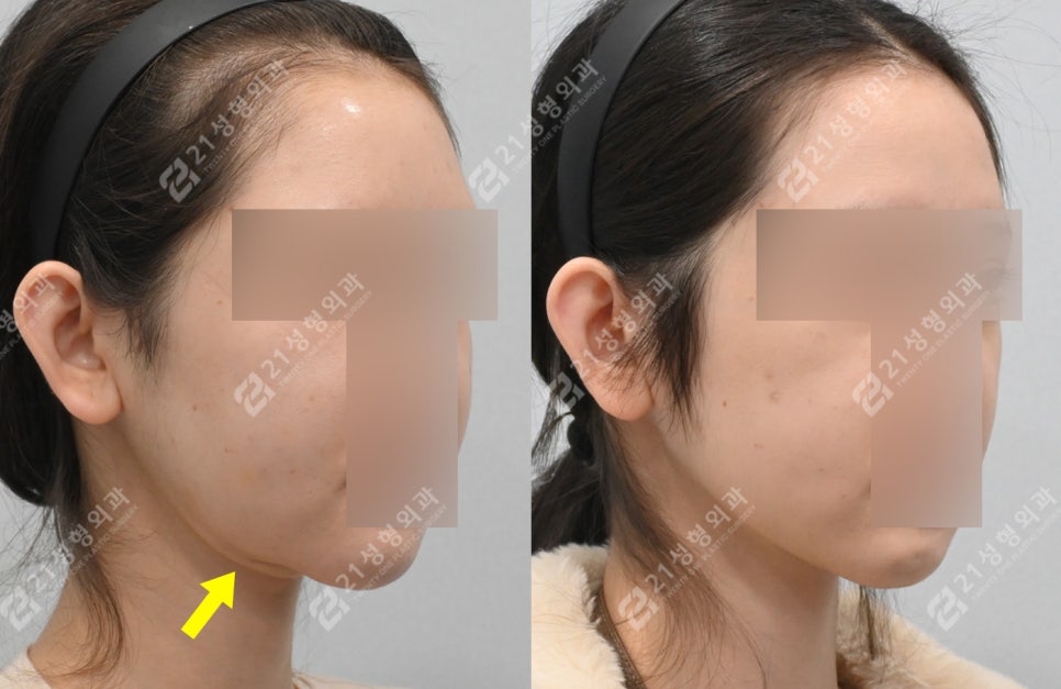 이중턱 수술 후 턱밑 피부가 접혔는데 이게 정상이라고요? 관련 이미지 4