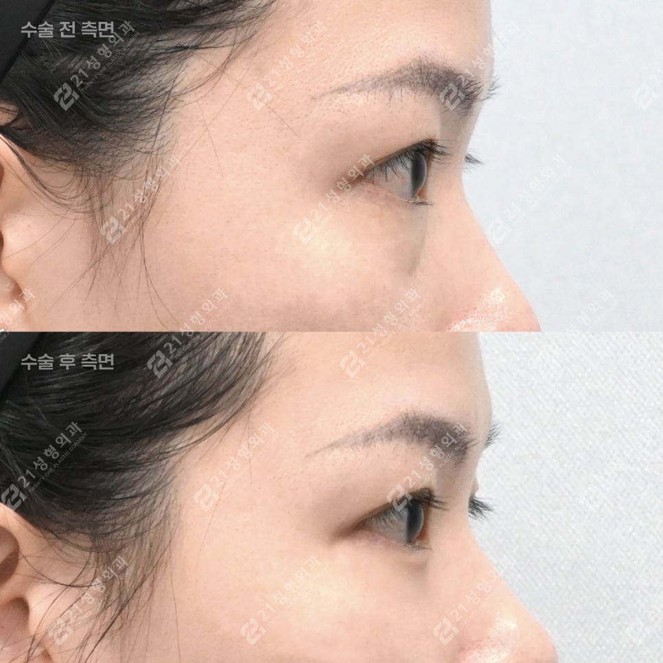 눈밑지방재배치, 30대인데 피곤해 보이는 이유 관련 이미지 4