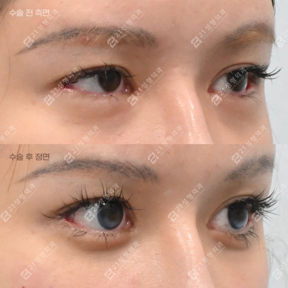 The Reason Lower Eyelid Fat Repositioning Is Needed, Explained Through the Structure Under the Eyes image 4