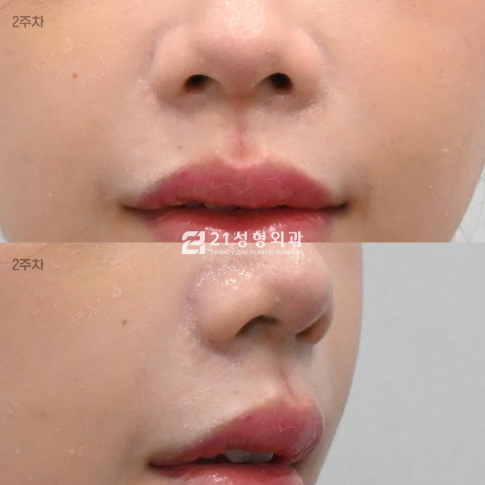 인중 흉터 없이 짧아 보이는 법? 성형외과 원장이 밝히는 인중 라인 착시 효과 관련 이미지 5