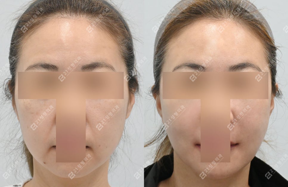 Facial and Neck Lift: The Key Is Structure, Not Skin | Real Before-and-After Review image 1