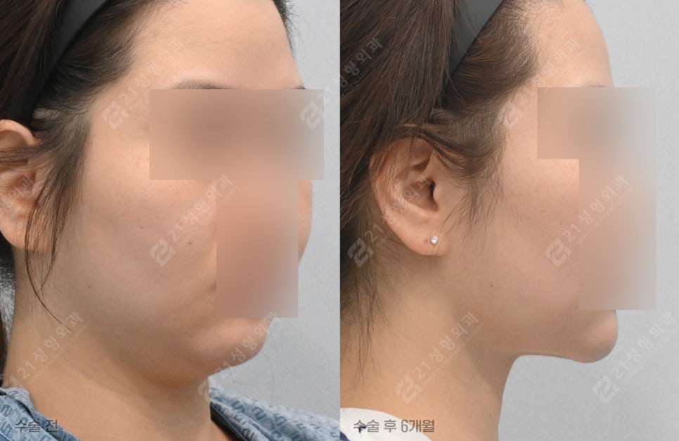 이중턱, 만져보면 원인이 보입니다 -21성형외과가 4가지로 나누는 이유 관련 이미지 7
