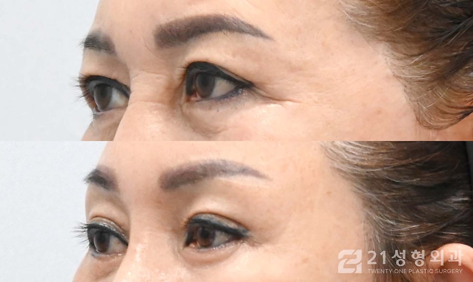 50대쌍꺼풀 일반 눈 수술과 다릅니다 관련 이미지 2