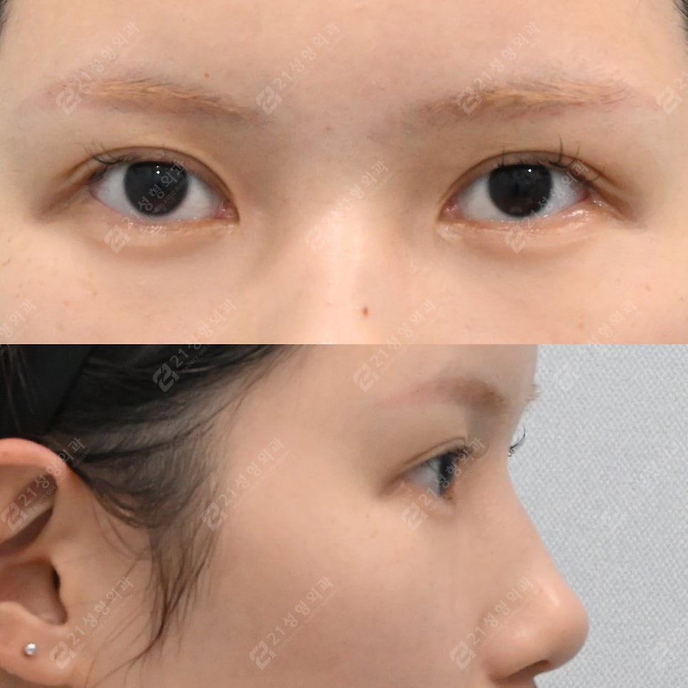 전후사진으로 분석하는 다크서클과 눈물고랑의 차이 관련 이미지 5