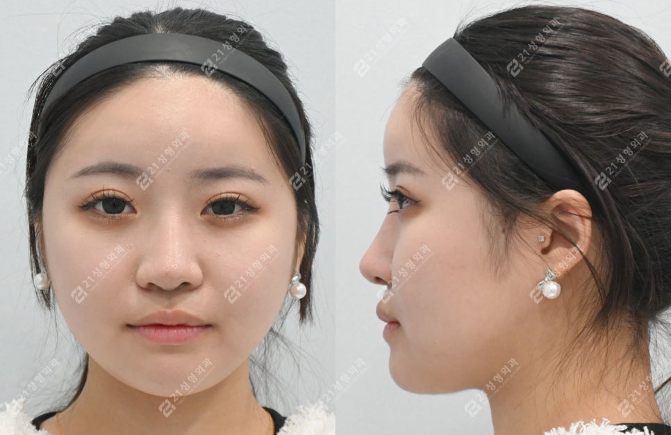 Real Review of Square Jaw Surgery: Square Jaw Surgery Is Not Over After Just Shaving the Bone image 6