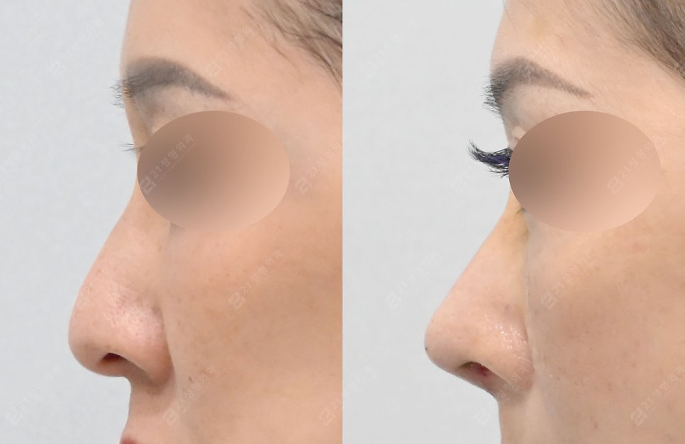 A Real Nose Surgery Review That Combines Safety and Naturalness image 1