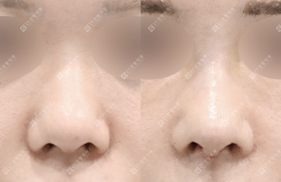 How to Create a Flawless Nose Line | Real Review of Rib Cartilage Rhinoplasty image 3
