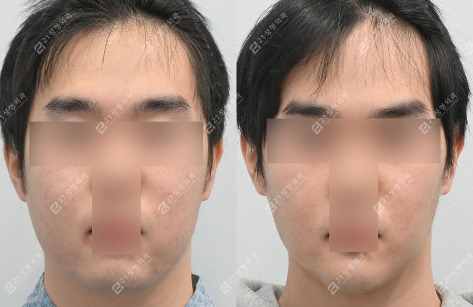 Male Double Chin + Chin Advancement Surgery Real Case: Why the Mood and Impression Change image 1