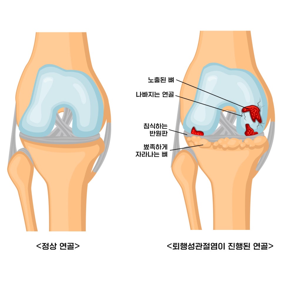 자가줄기세포가 가져온 무릎 통증 치료의 새 시대 관련 이미지 2