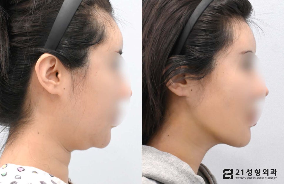 투턱없애기 이중턱근육묶기로 해결 관련 이미지 3