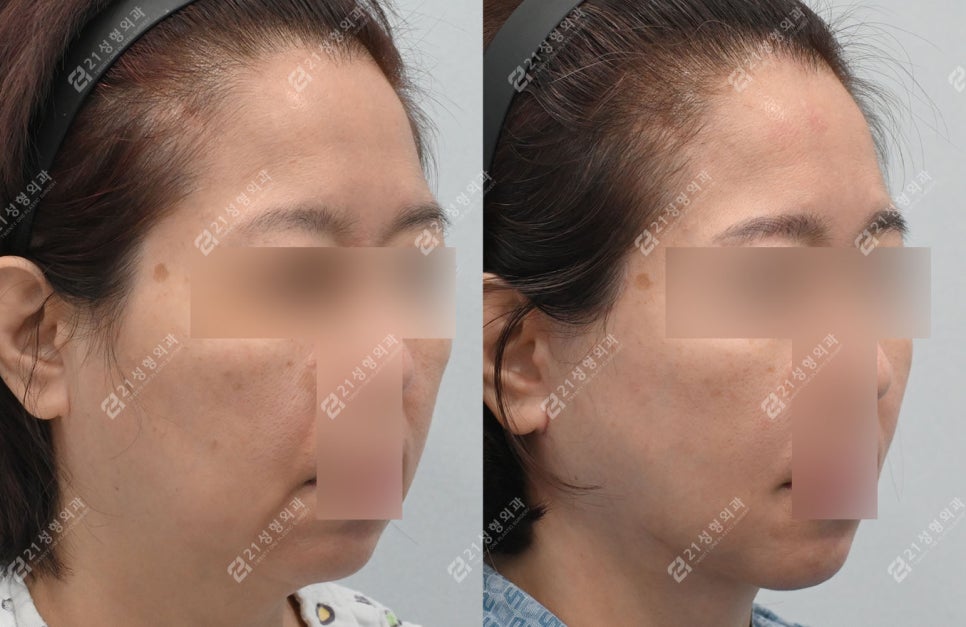 거상 수술의 효과를 극대화하는 방법, 안면목거상 + 근육묶기 케이스 관련 이미지 1