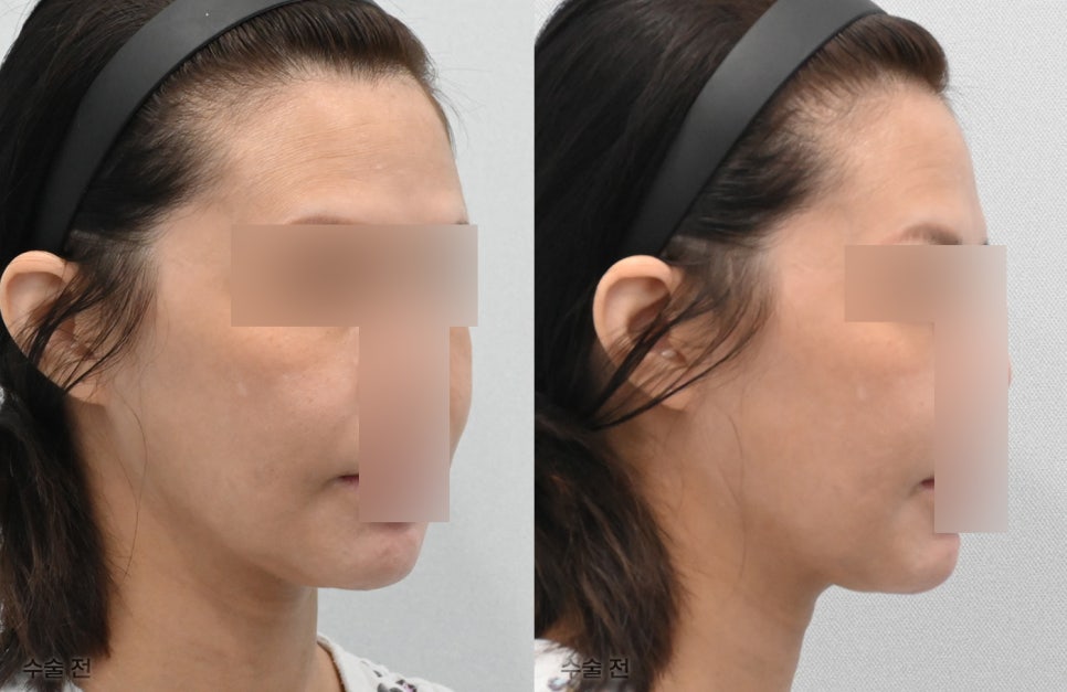 Pixie Ears After a Facelift: Why Do They Differ from Clinic to Clinic? Find Out at 21 Plastic Surgery image 4