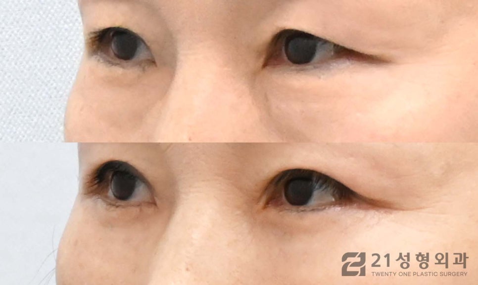 하안검수술잘하는병원 선택 노하우는 관련 이미지 2