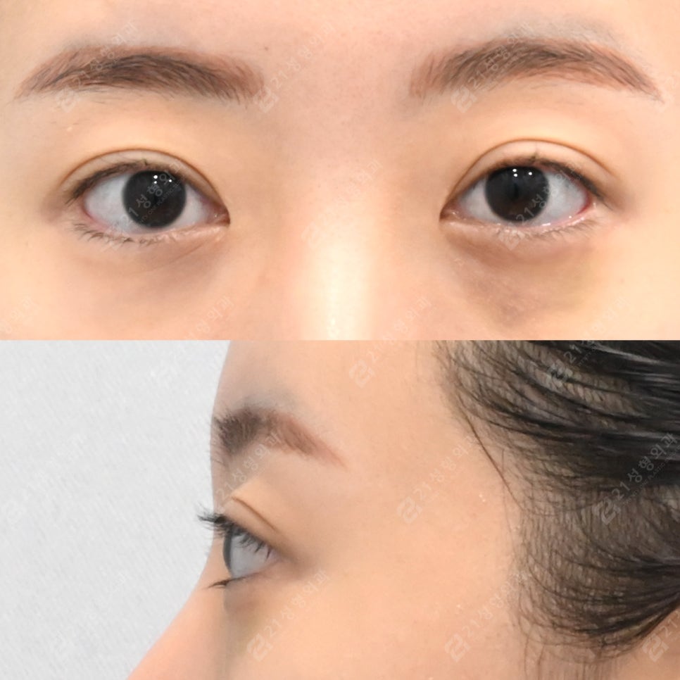 똑같은 눈밑수술도 결과가 다른 이유 관련 이미지 3