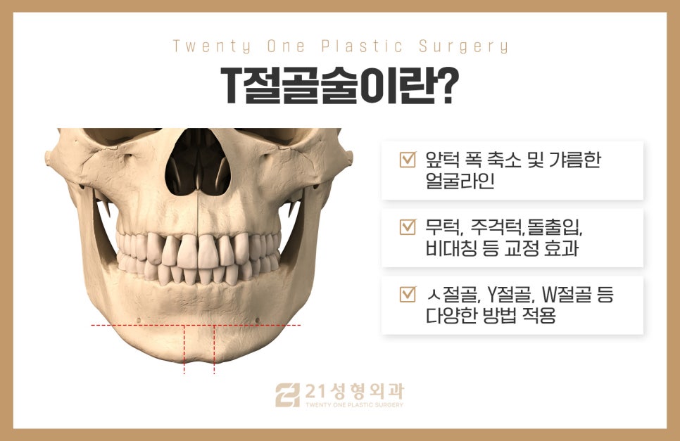 턱끝성형으로 양악 없이 주걱턱해결 관련 이미지 7
