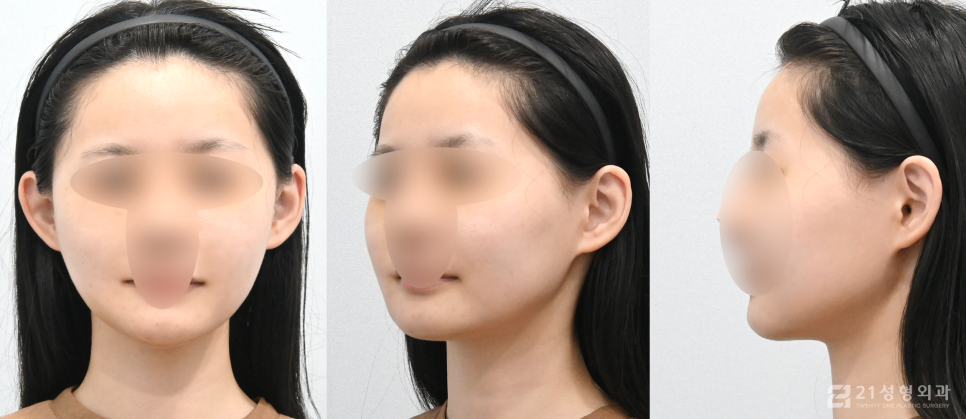 안면윤곽잘하는병원 선택할 때 중요한 점 관련 이미지 5